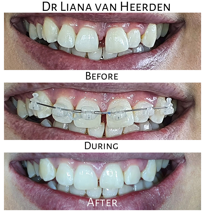 Before & After nr.2.c