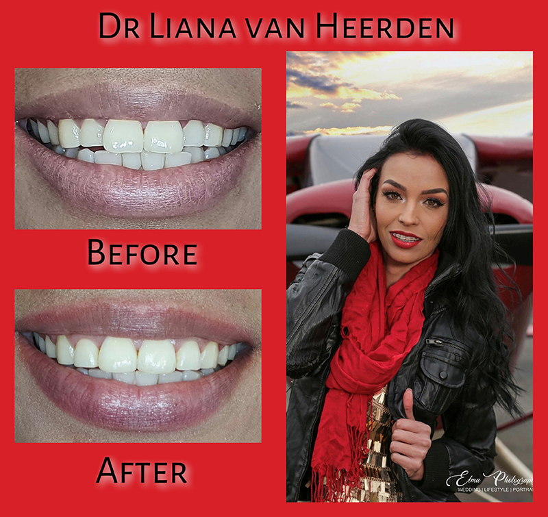 Before & After nr.4