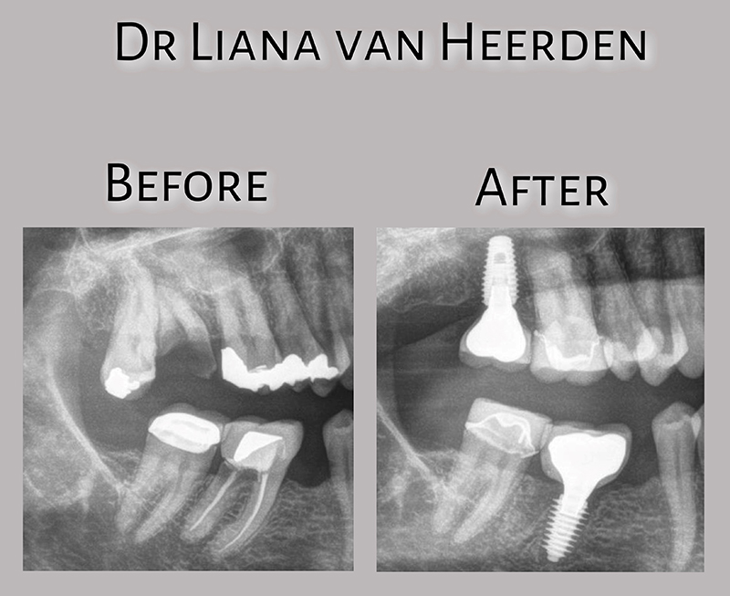 Before & After nr.6